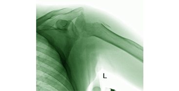 Повреждение плечевого сустава