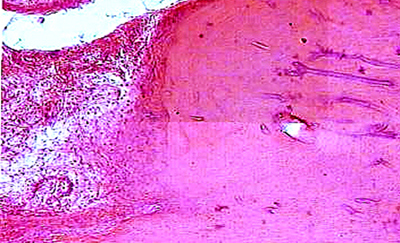 Нарушение остеотрепанации