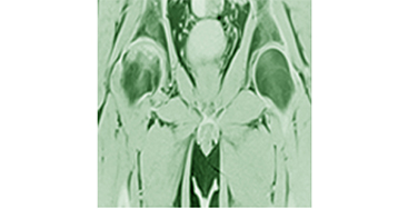 Артрози великих суглобів