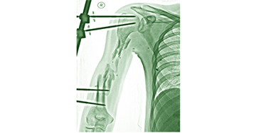 Дефекти кісток кінцівок