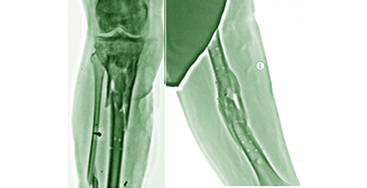 Деформации конечностей