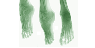 Деформації стоп