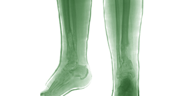 Остеомиелит костей конечностей