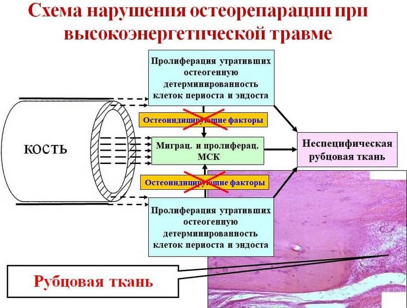 Клеточные механизмы нарушения сращения переломов